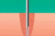 1 Wand STA jest jedynym urządzeniem do znieczuleń z technologią DPS Dynamiczny Pomiar Ciśnienia (Dynamic Pressure Sensing).