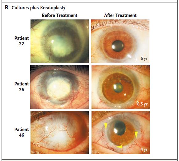 burns. P. Rama (G. Pellegrini) et al., NEJM 2010 http://www.
