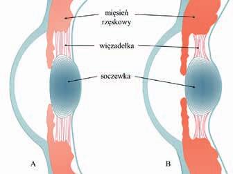 mięśnia rzęskowego a zakres (amplituda) akomodacji zmniejsza się (Rys. 3), osiągając w wieku około 55-60 lat amplitudę akomodacji około 1 dioptrii. Oko staje się prezbiopijne.