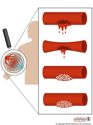 HEMOSTAZA uszkodzenie naczynia skurcz naczynia hemostaza pierwotna pierwotny czop płytkowy skrzep fibrynowy