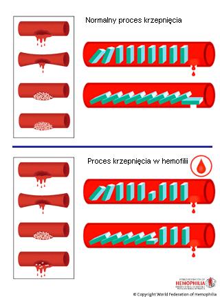 Osoczowy układ krzepnięcia krwi 12 białek osoczowych czynników krzepnięcia ich kaskadowa aktywacja powoduje przejście fibrynogenu w fibrynę i stworzenie odpornego