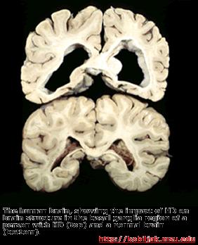 Choroba Huntingtona Postępująca degeneracja tkanki mózgu