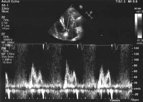 Napływ przez zastawkę mitralną w czasie stymulacji AAI 70/min (odstęp PR równy 320 ms w zapisie elektrokardiograficznym) AV VTI (aortic valve velocity time integral) równej 16,3 cm, wynosiła 62 ml.