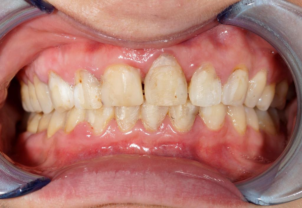 W pierwszym etapie tego leczenia wykonano diagnostyczne nawoskowanie modeli wstępnych (wax-up) aby uzyskać zadawalający pacjentkę efekt estetyczny przyszłych uzupełnień protetycznych.