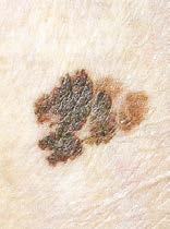 Melanoma malignum można wykryć na podstawie badania przedmiotowego, które obejmuje określenie cech klinicznych [13].