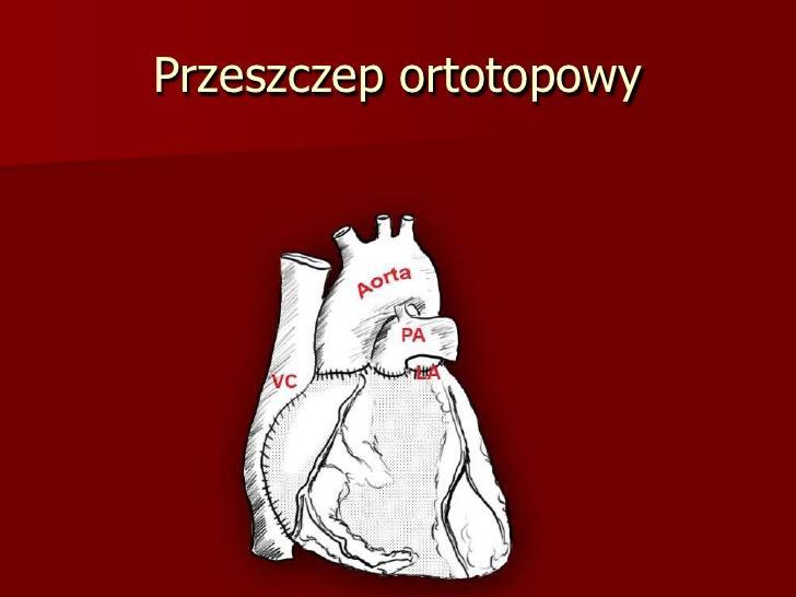 Przeszczep Ortotopowy opracowany w 1960 roku przez Lowera i Schumwaya jest dla wielu chirurgów złotym standardem w transplantologii serca.