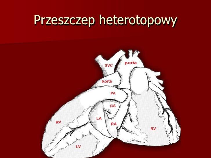 Przeszczep Heterotopowy Początkowo był metodą wspomagania lewej komory.