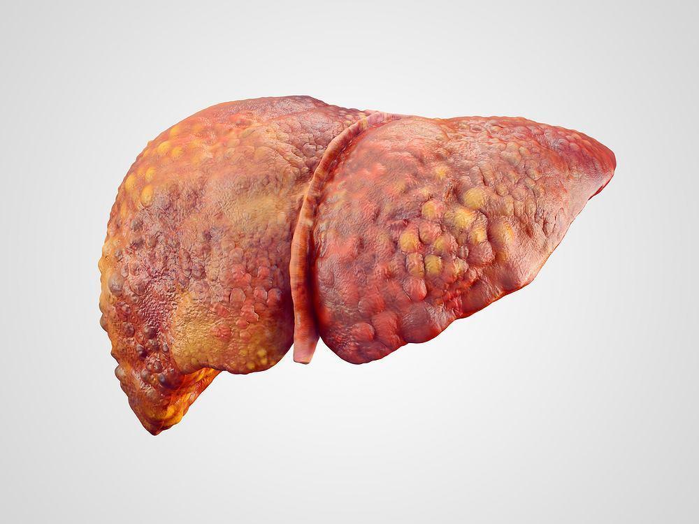 W jakich przypadkach przeprowadza się transplantacje wątroby?