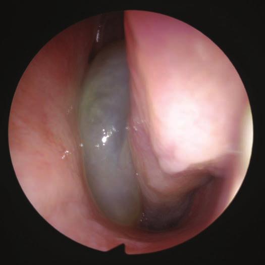 Bilateral antrochoanal polyp: case report, literature review and clinical guidelines a b c d e Fig. 1a-e.