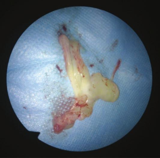 inhabited the nasopharynx (at 12 o clock), maxillary sinus (7 o clock), nasal cavity (3 o clock); c right-side nasal cavity antrochoanal polyp before removal; d, e condition after removal of the
