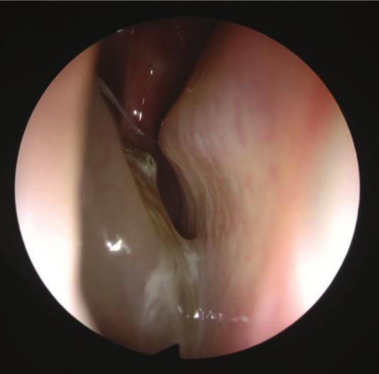 The gold standard is endoscopic sinus surgery.