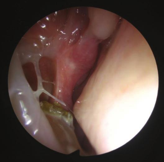 within the sinus. Antrochoanal polyps are unilateral lesions. The literature contains only isolated case reports on bilateral lesions of this type (8-12).
