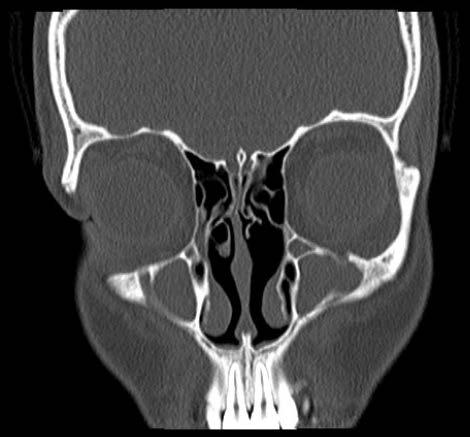 Bilateral antrochoanal polyp: case report, literature review and clinical guidelines a b c d e f Fig. 2a-g.
