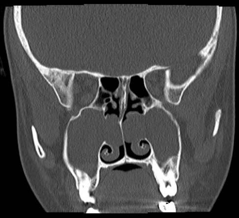 Histologically, ACPs are characterized by neutrophilic infiltrates, unlike polyps arising from the ethmoid sinuses which reveal predominantly eosinophilic