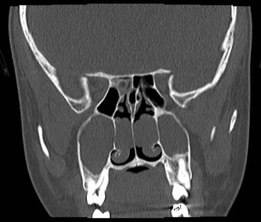 Certain anatomical anomalies in the lateral wall and nasal septum deviation have been observed as predisposing factors to the development of antrochoanal