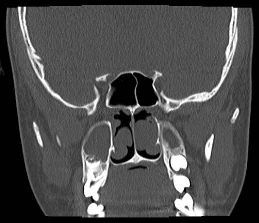 Also, the ACP group was found to have a greater frequency of nasal septal deviation (usually on the opposite side of the ACP), compared to the control group