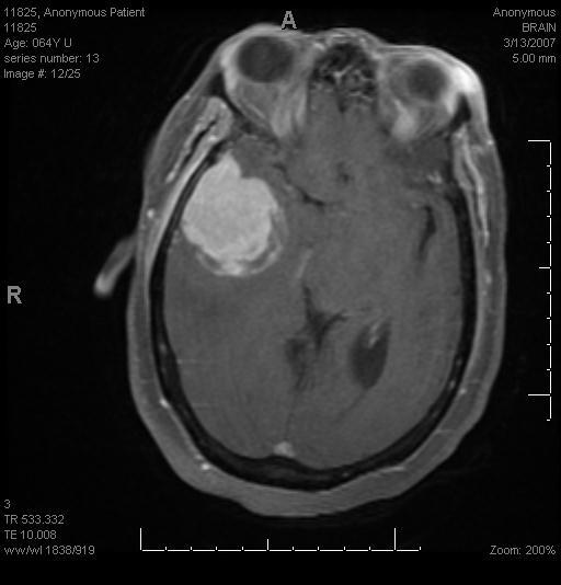 Przykłady zmian w CSN MRI z kontrastem, widok