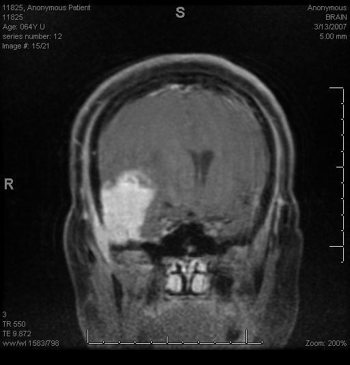 prawej stronie (przed resekcją) MRI z