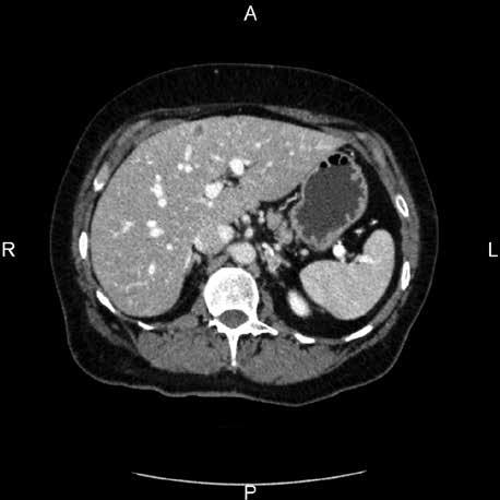 ONKOLOGI W PRKTYCE KLINICZNEJ EDUKCJ 2018, tom 4, supl. Rycina 5. Ognisko przerzutowe w lewym nadnerczu w wyjściowym () i kontrolnym () badaniu TK Piśmiennictwo 1.