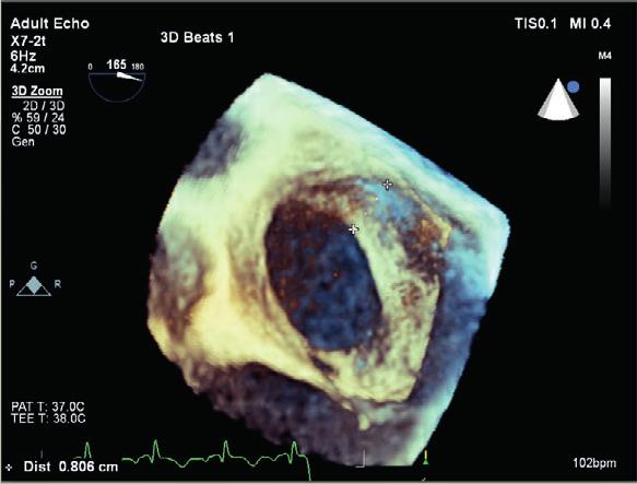 Kardiologia Inwazyjna nr 4 (12), ROK 2016 40 Closure of ASDs in elderly patients resulted in signifi cant clinical and hemodynamic improvement after percutaneous treatment, which requires long-term