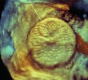 Wraz z coraz większą dostępnością narzędzi diagnostycznych i echokardiografii rośnie liczba chorych starszych, u których często przypadkowo podczas diagnozowania innych chorób towarzyszących