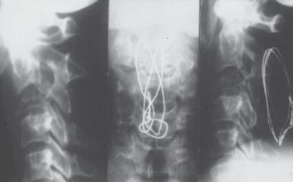 44 T. MAZURKIEWICZ, P. POLAK, J. GĄGAŁA Fig. 1. (a) Renal cancer metastasis to the vertebral body C3 with significant instability and subluxation.