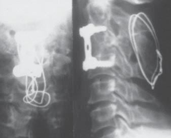 (c) After 2 weeks radiotherapy, and after 2 subsequent weeks removal of the vertebral body, completing the defect with an iliac ala graft and