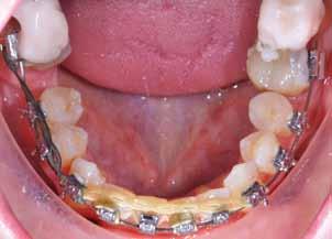 Extraoral and intraoral images after Haas appliance
