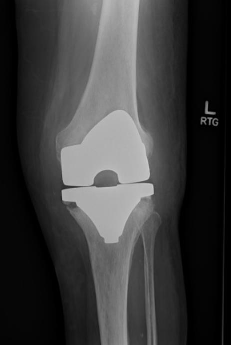 Diagnostyka PJI w badaniach