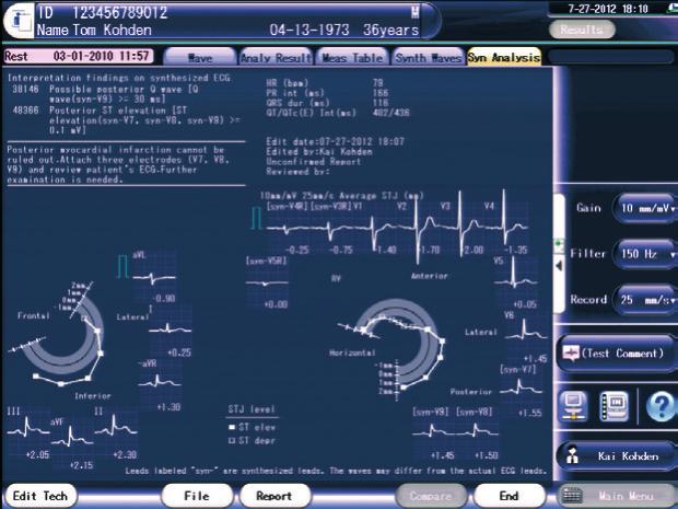 Program analizy EKG ECAPS 12C firmy Nihon Kohden podaje ponad 200 wniosków ze szczegółową analizą. Syntetyzowane 18-odpr.