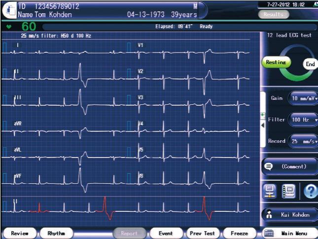 V9) Wyświetlanie analizy ułatwia wizualizację zmian odcinka ST Aparat ECG-2550 zawiera nowy program analizy, ECAPS 18.