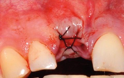 Posiłkując się zdjęciem CBCT tej okolicy, zaplanowano implant o długości 13 mm oraz średnicy 4,0 mm firmy Biomet 3i.