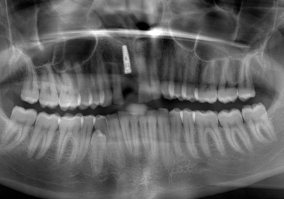 8. Kontrolne zdjęcie RTG panoramiczne po zabiegu wykazało prawidłowo spozycjonowany implant. 9.