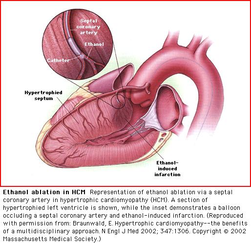 4- Alcohol septal ablation (NSRT) Controlled myocardial infarction of the basal ventricular