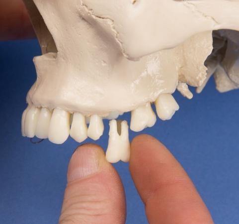 Istnieje możliwość demontażu poszczególnych zębów.