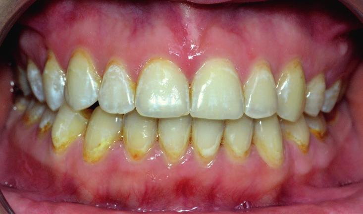 2 3 Ryc. 2. Liczne odwapnienia na powierzchniach wargowych zębów po leczeniu ortodontycznym Ryc. 3. Natychmiastowy efekt uzyskany u pacjentki w procesie leczenia WSL na zębach 13-23 oraz 34-44 etiologii procesu próchnicowego i rozwoju materiałów adhezyjnych.