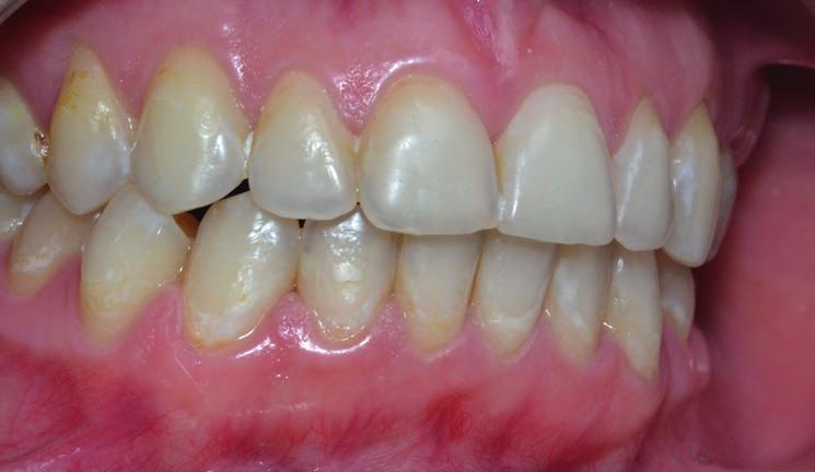 Ten mikroinwazyjny sposób leczenia pozwala na zachowanie twardych tkanek zęba [26].