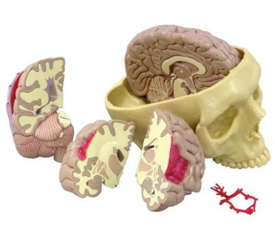 Model chorób mózgu Nr ref: MA00684 Informacja o produkcie: Model anatomiczny przedstawiający patologie mózgu Naturalnych rozmiarów model przeznaczony do nauki anatomii.