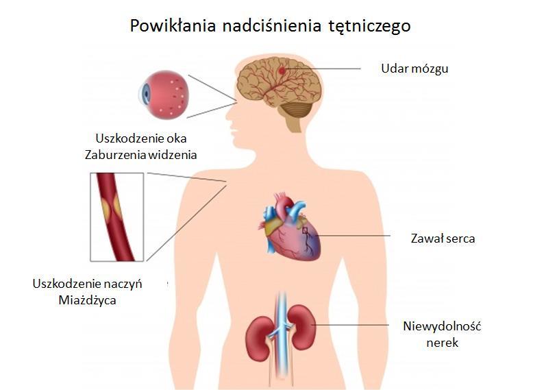 Do rozpoznania nadciśnienia tętniczego wystarcza przekroczenie (w kilkukrotnych pomiarach) normy dla jednej z tych wartości (nadciśnienie może zatem polegać na zbyt dużych wartościach tylko ciśnienia