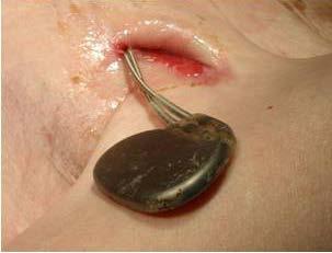 FIGURE 1 A pocket infection; B, C lead loops on X-ray fluoroscopy imaging; D, E extracted endocardial leads showing abrasive damage to lead loops due to friction A B C D E of CIED infections was