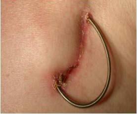 1,7 CIED infections occur both early and late after implantation of electronic devices (>1 year after the procedure).
