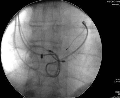 PATIENTS AND METHODS Study population Clinical data from 1837 patients undergoing transvenous lead extraction (TLE) in a reference center between 2006 and 2015 due to late (>1 year) complications