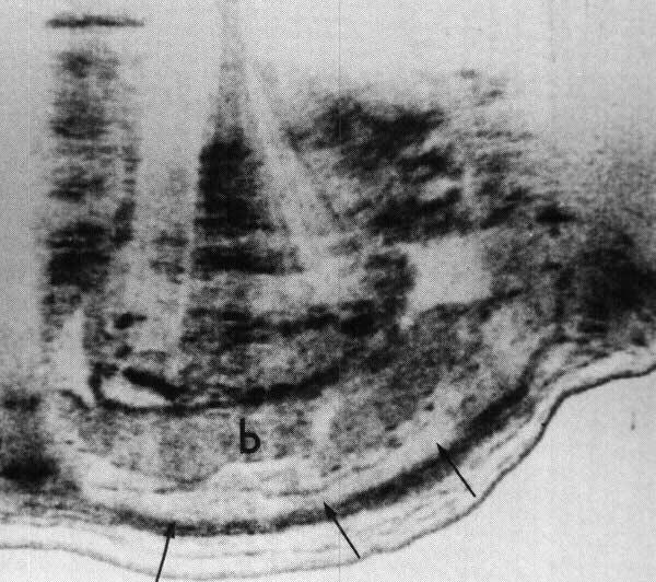 Dwa obrazy, dziury w łożysku (obecnie III stopień dojrzałości) oraz krwiaka podłożyskowego przedstawiają posiadające już znaczenie historyczne ryciny 1 i 2.