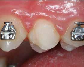 against the palatal surface POMIAR