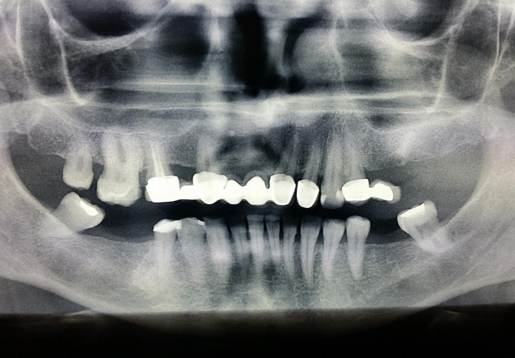 The prosthetic restorations had incorrect profile, the pontic was located too close to the alveolar ridge and the interdental papillae were not unburdened, which made oral care problematic.