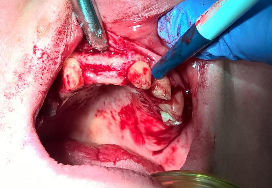 Osteotomy and osteoplasty on vestibular and approximal surfaces of teeth were done. Through root surface debridement was performed. The obtained result was comapered with the surgical template.