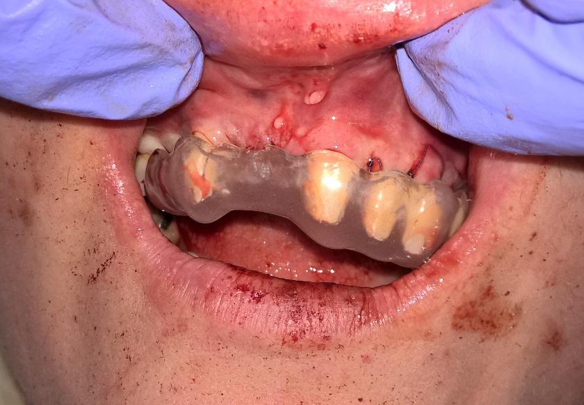 Situation attwo weeks after surgery; satisfactory gingiva condition with visible spaces between temporary pontics and the gingival margin. Ryc. 11.