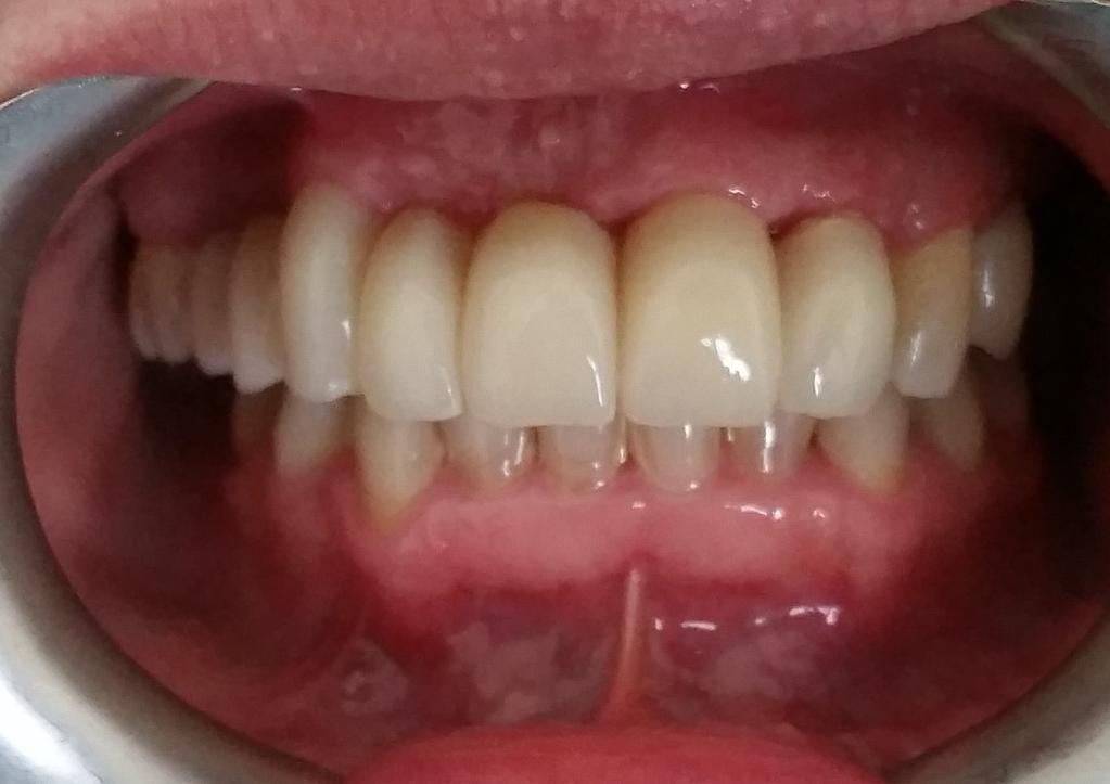 and phonetically (Fig. 11). In addition, due to root exposure the patient reported slight teeth hypersensitivity to exogenous influences.