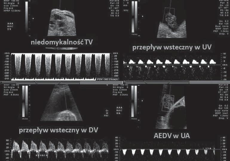 Rycina 2. Obraz ilustruje nieprawidłowe wyniki badań dopplerowskich u biorcy w 19 t.c. u góry po stronie lewej holosystoliczna niedomykalność zastawki TV; u góry po stronie prawej skrajnie