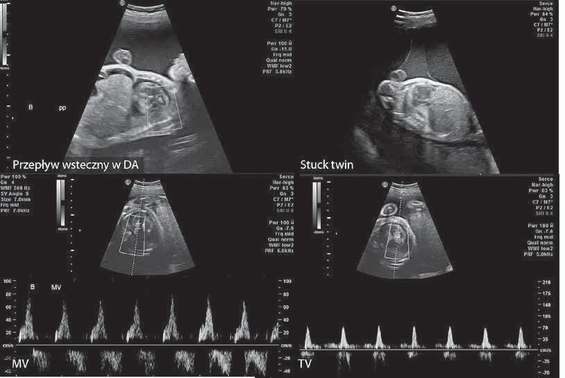 Rycina 4. Obraz ilustruje badanie ultrasonograficzne płodów w 26 t.c. w zespole TTTS po stronie prawej u góry dawca stuck twin otoczony ściśle błonami płodowymi, zawieszony w worku owodniowym biorcy